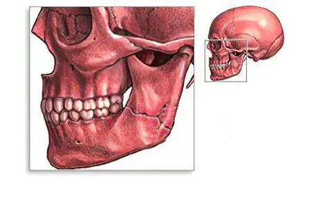 Fracture of the upper and lower jaw