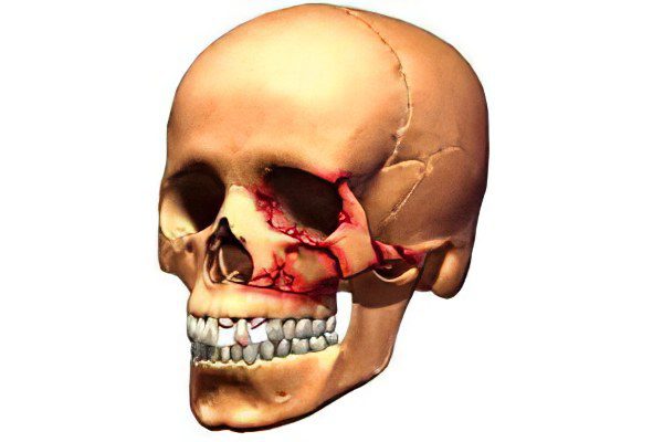 Fracture of the upper and lower jaw