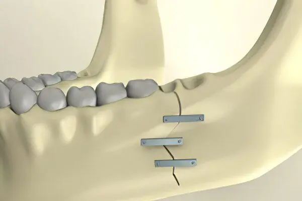 Fracture of the upper and lower jaw