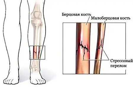 Fractures of the fibula