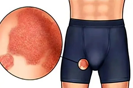 Fungus in the groin in men and women