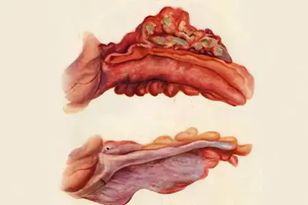 Gangrenous appendicitis