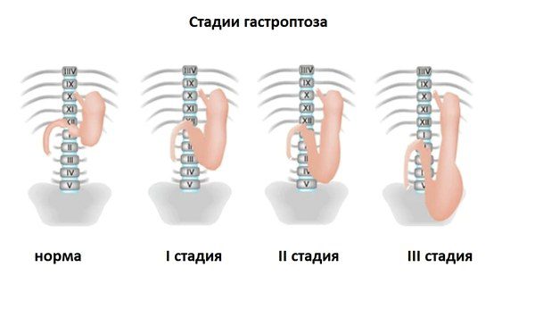 Gastroptosis: causes, symptoms and treatment