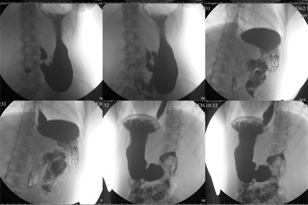 Gastroptosis: causes, symptoms and treatment