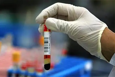 General blood test: decoding and norms