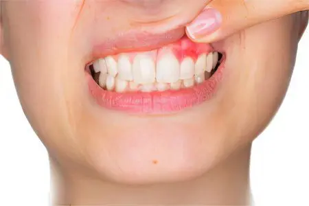 Gingivitis &#8211; symptoms and treatment