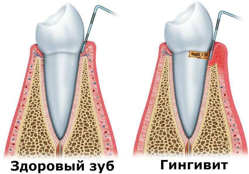 Gingivitis - symptoms and treatment