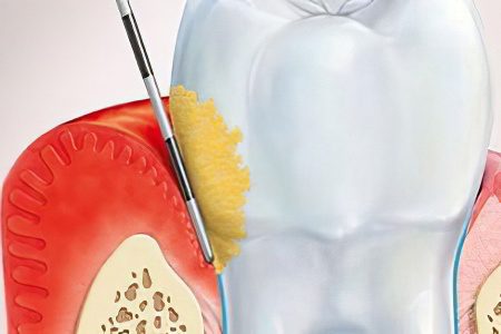 Gingivitis - symptoms and treatment