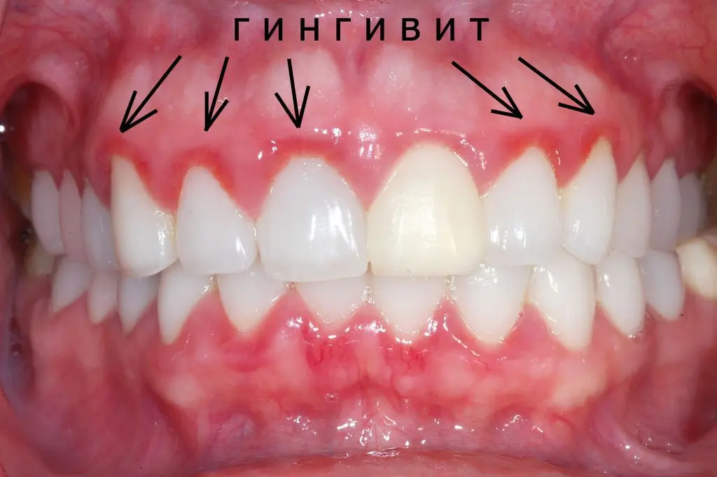 Gingivitis - symptoms and treatment