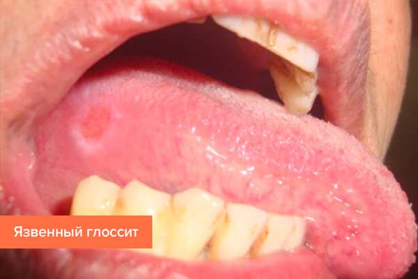 Glossitis: types, symptoms and treatment