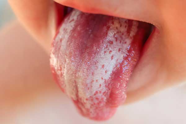 Glossitis: types, symptoms and treatment