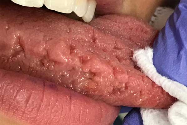 Glossitis: types, symptoms and treatment