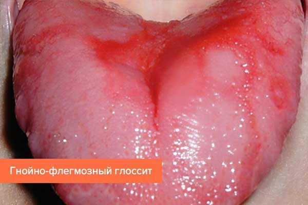 Glossitis: types, symptoms and treatment