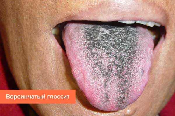 Glossitis: types, symptoms and treatment