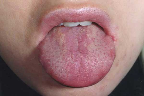 Glossitis: types, symptoms and treatment