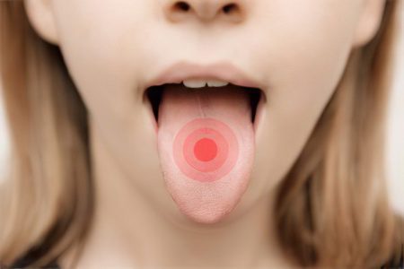 Glossitis: types, symptoms and treatment