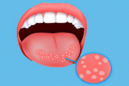 Glossitis: types, symptoms and treatment