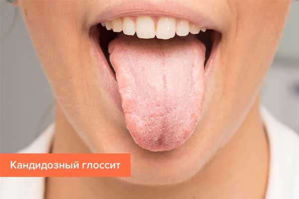 Glossitis: types, symptoms and treatment