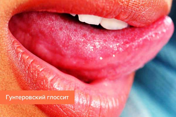 Glossitis: types, symptoms and treatment