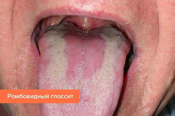 Glossitis: types, symptoms and treatment