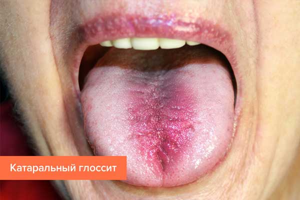 Glossitis: types, symptoms and treatment