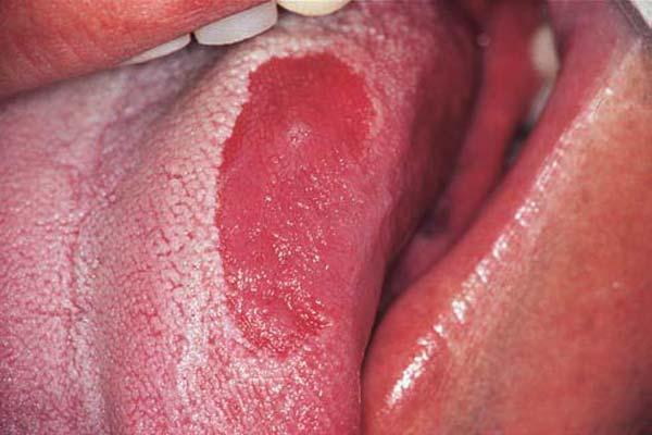 Glossitis: types, symptoms and treatment