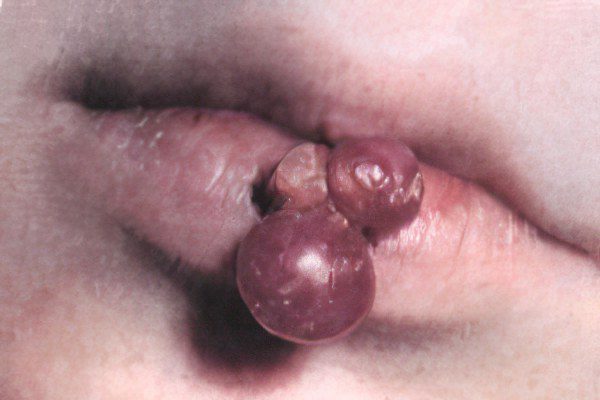 Granuloma of the skin, face, lips