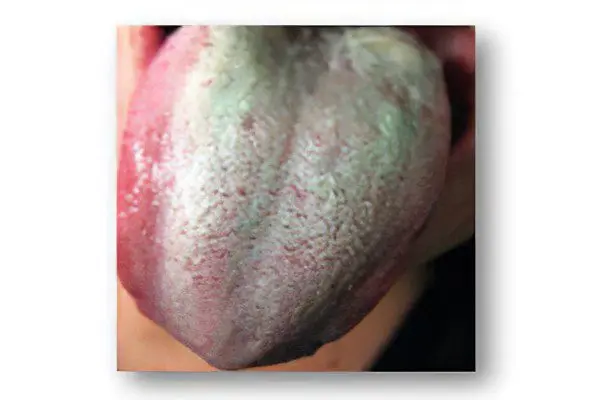 Green coating on the tongue