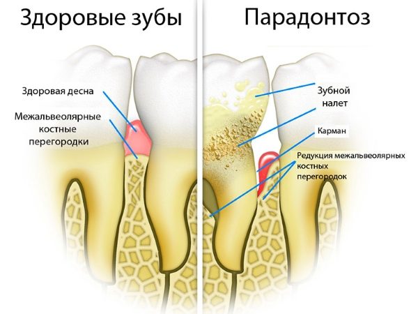 gum disease