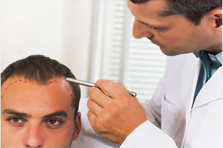 Hair transplant: answers to basic questions