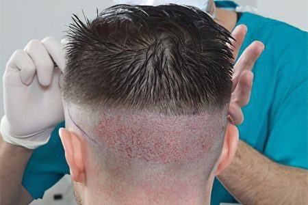 Hair transplant: answers to basic questions