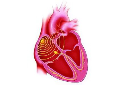 Heart bradycardia: what is it? Symptoms and treatment