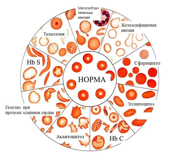 Hemolysis - what is it?