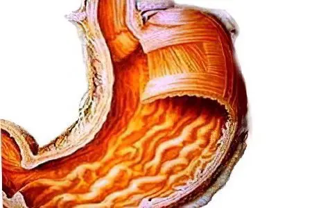 Hemorrhagic gastritis