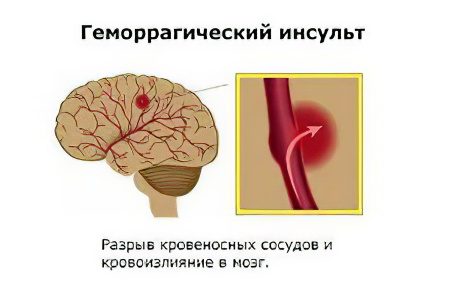 Hemorrhagic stroke