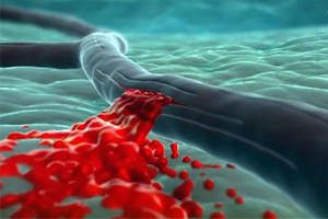 Hemorrhagic stroke