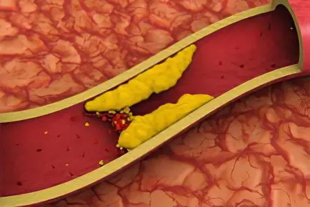 Hemorrhagic stroke