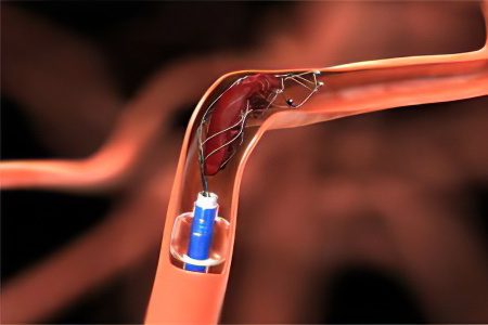 Hemorrhagic stroke