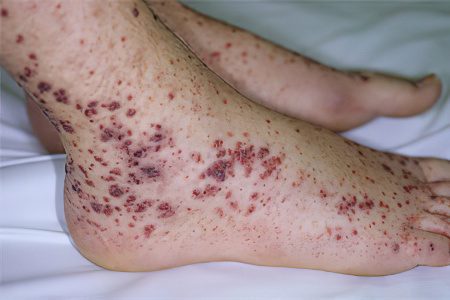 Hemorrhagic vasculitis