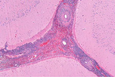 Hemorrhagic vasculitis