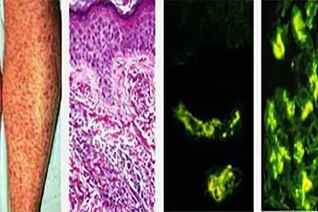 Hemorrhagic vasculitis