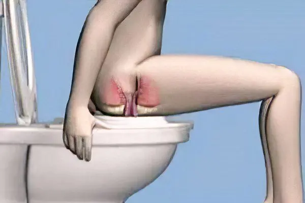 Hemorrhoids in women: the first signs, causes and treatment