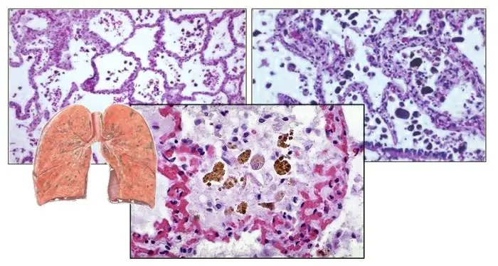 Hemosiderosis: symptoms and treatment