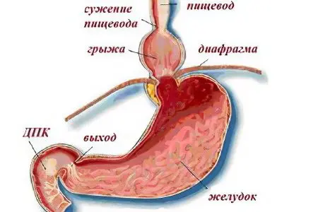 Hernia of the esophagus