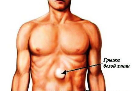 Hernia of the white line of the abdomen