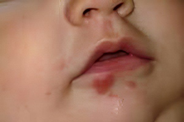 Herpes in children