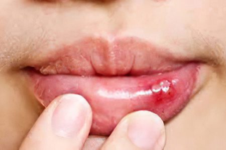 Herpetic stomatitis