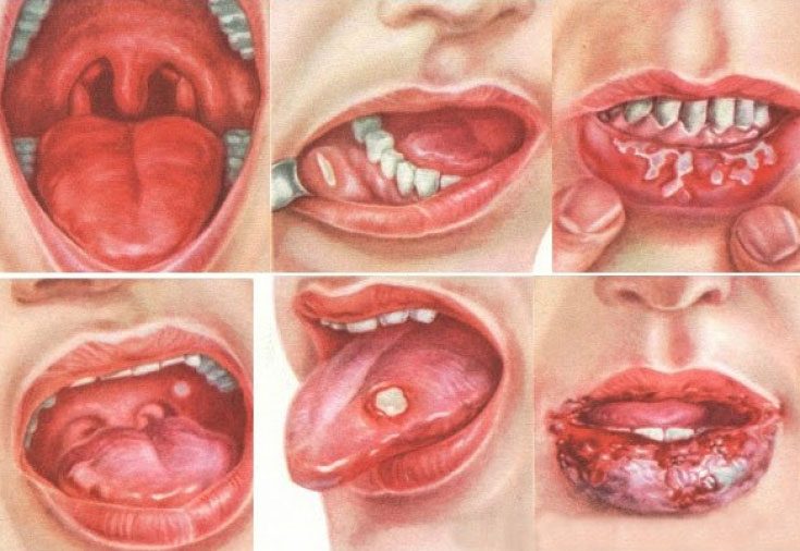 Herpetic stomatitis