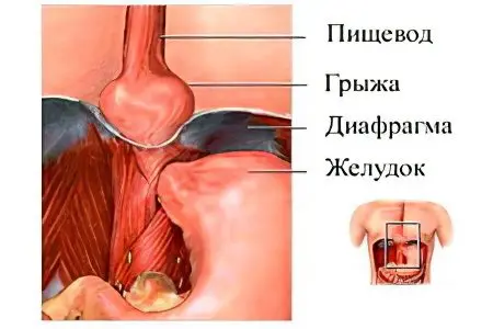 hiatal hernia (diaphragmatic hernia)