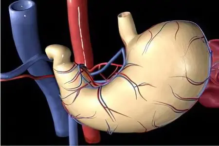 hiatal hernia (diaphragmatic hernia)